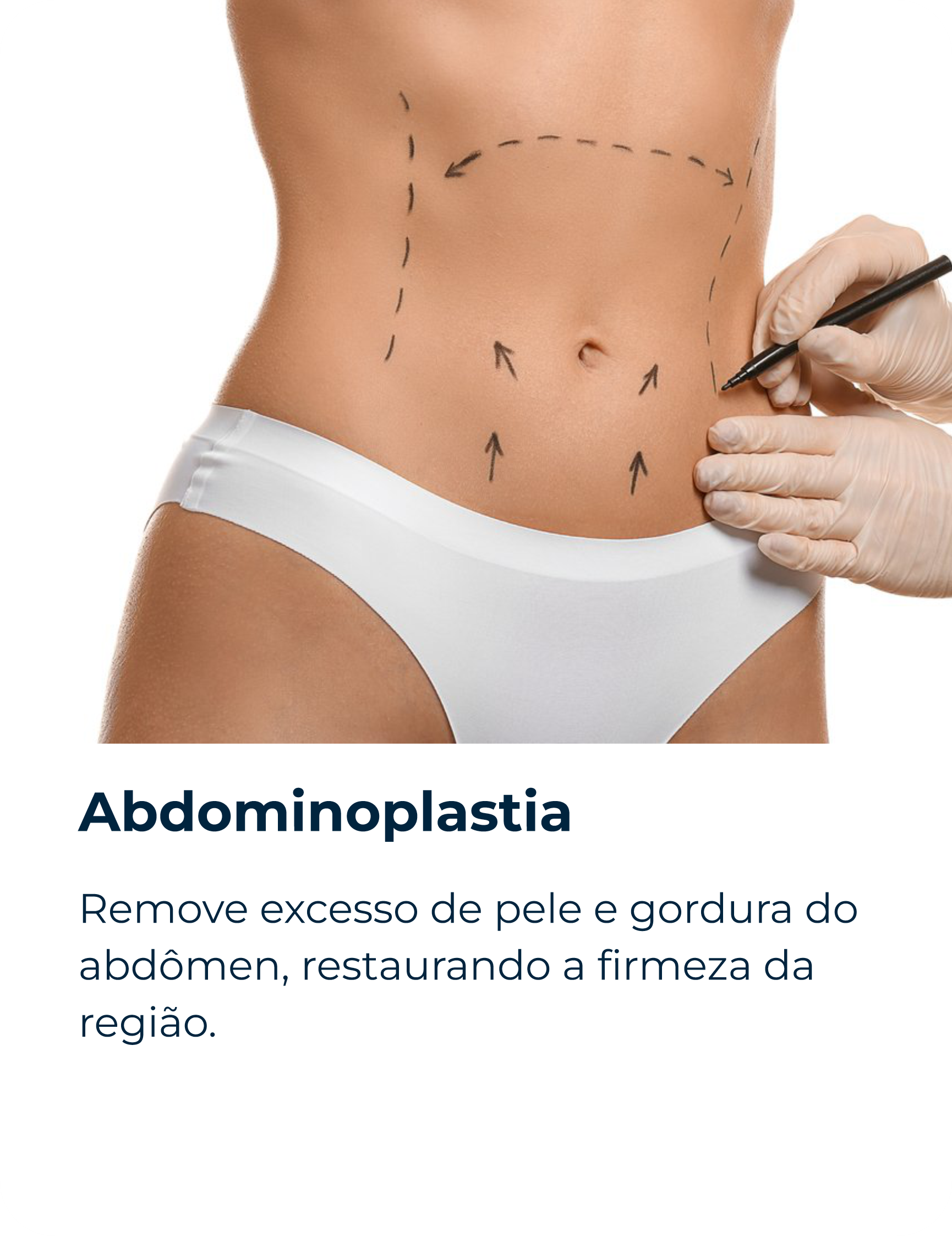 Abdominoplastia