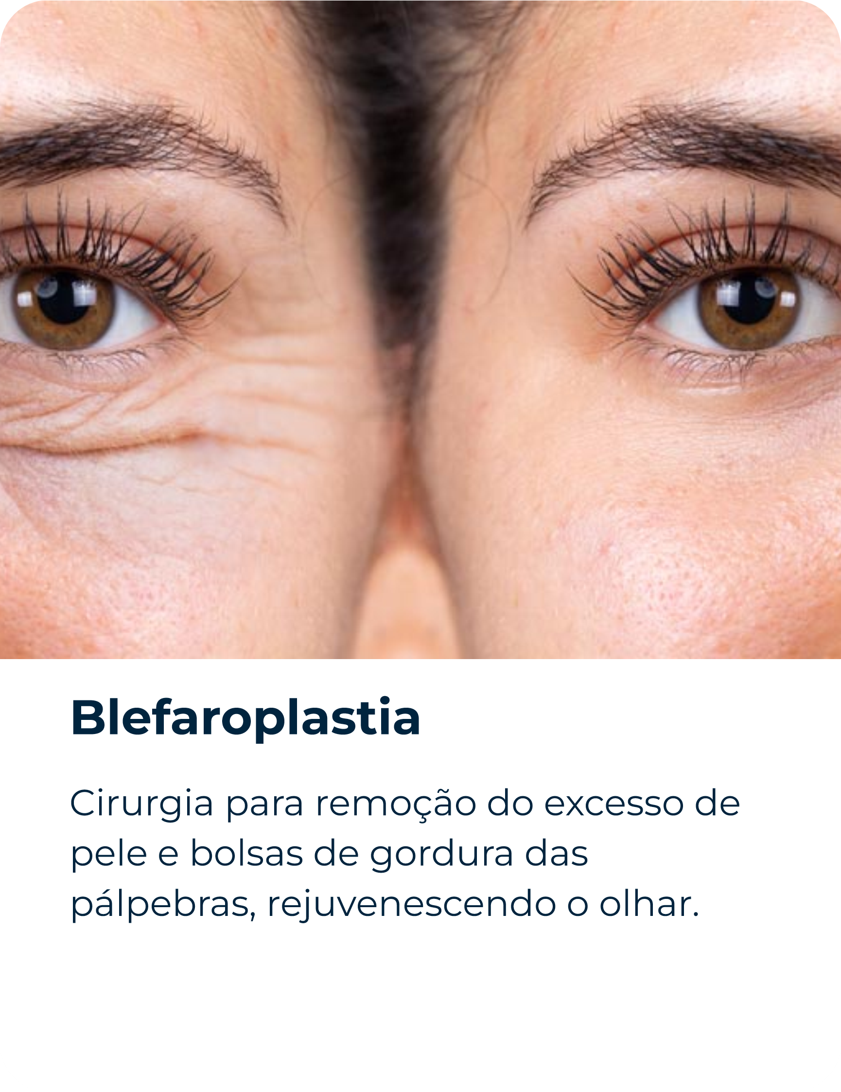 Blefaroplastia