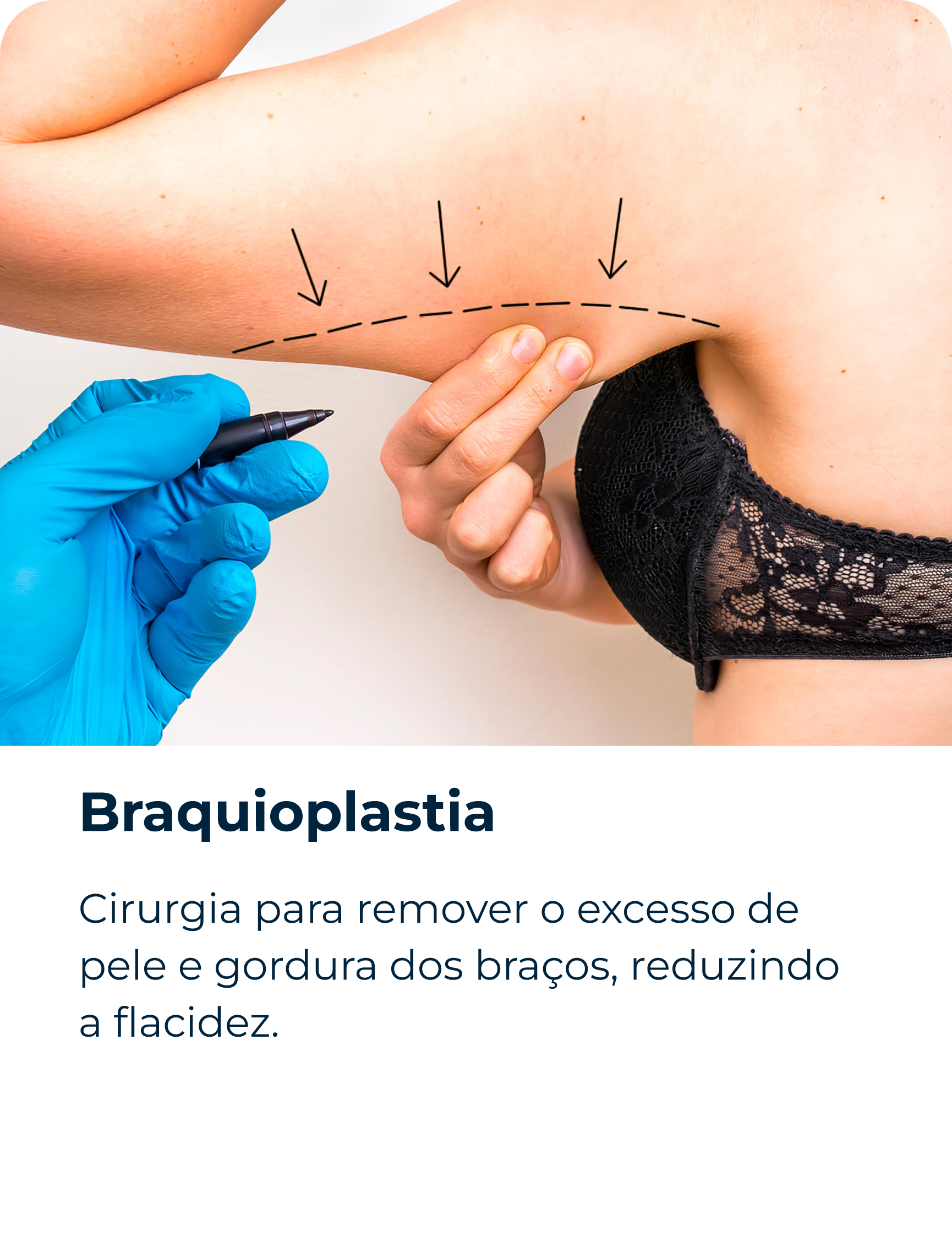 Braquioplastia