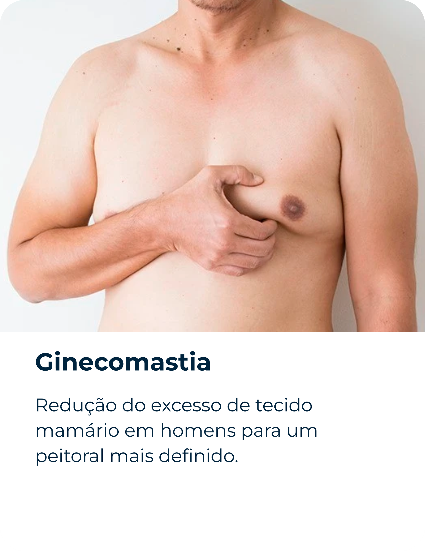 Ginecomastia
