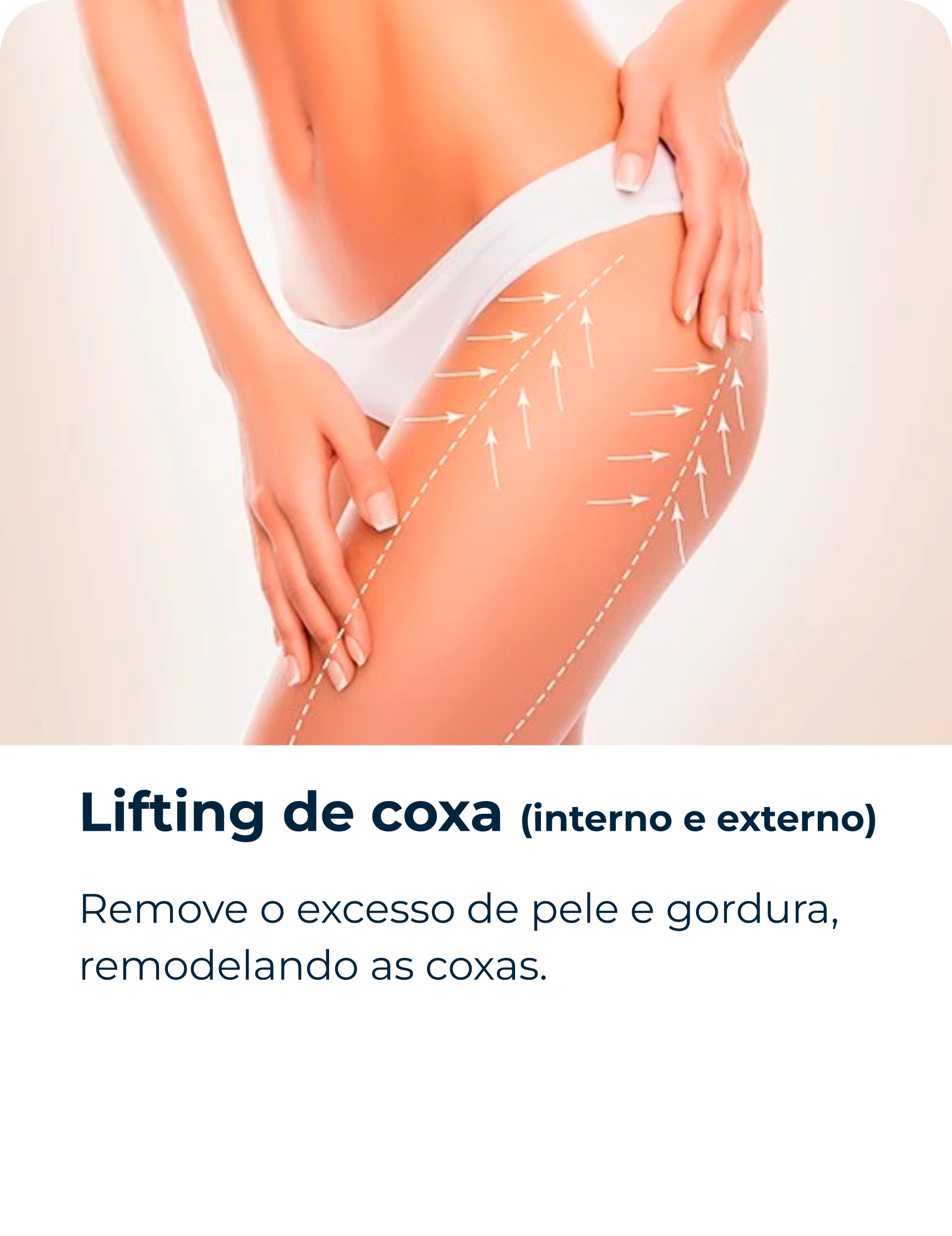 Lifting de coxa (interno e externo)