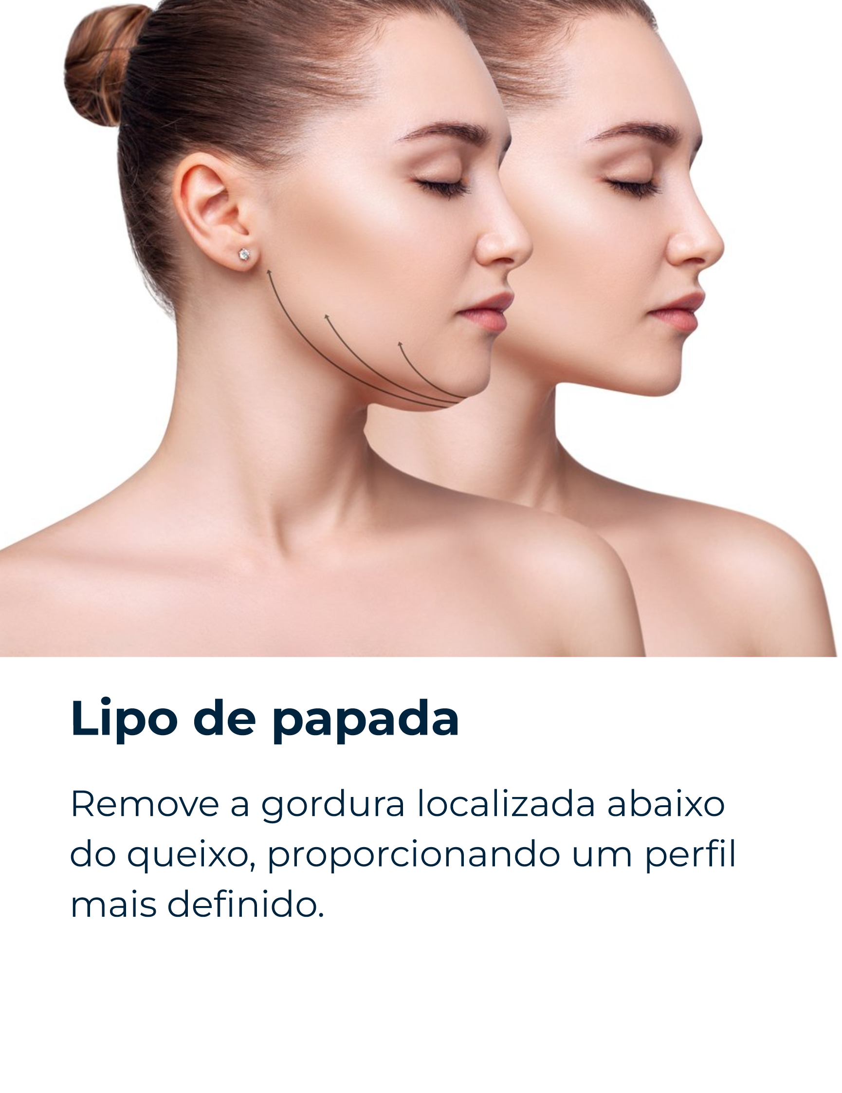 Lipo de papada