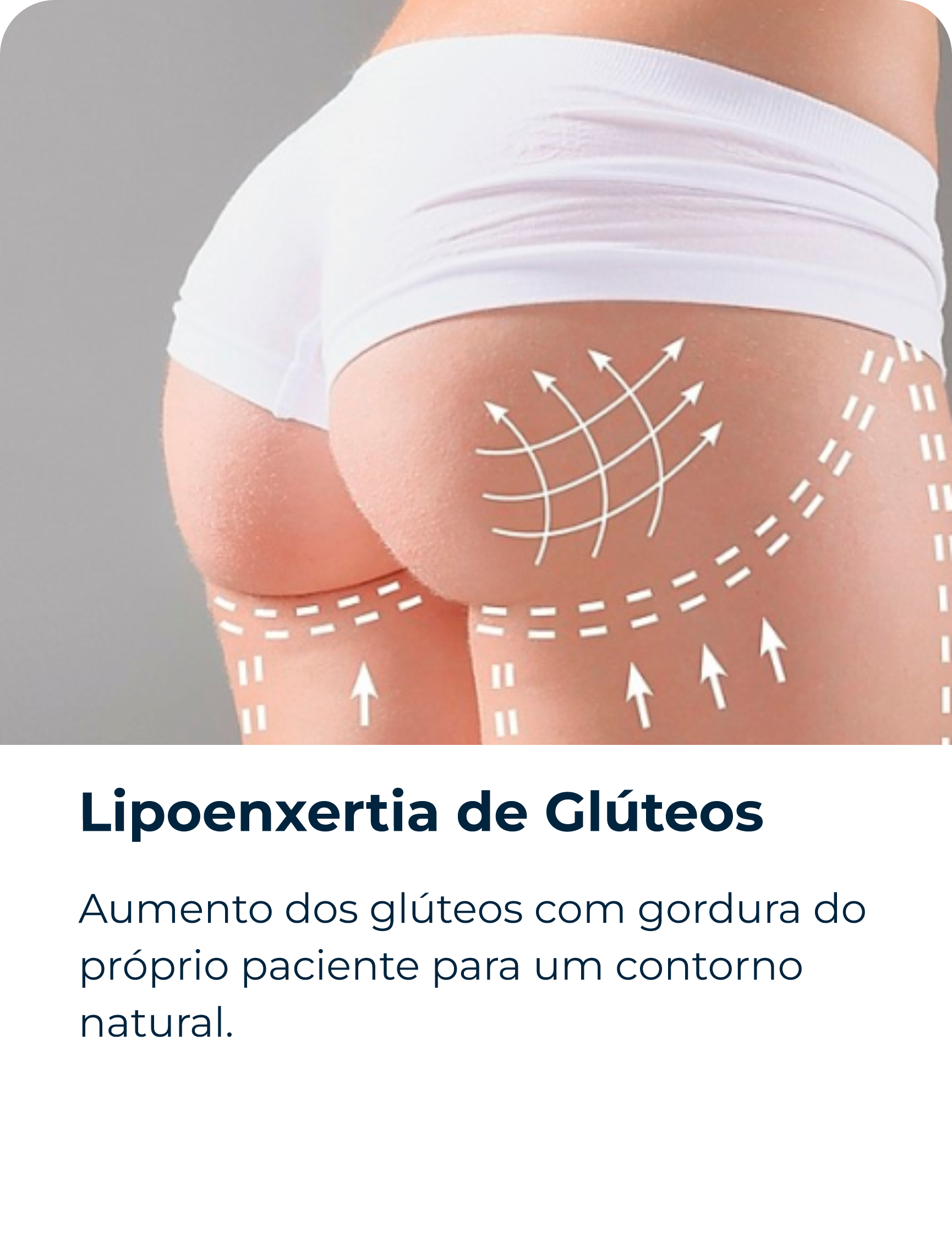 Lipoenxertia de Glúteos
