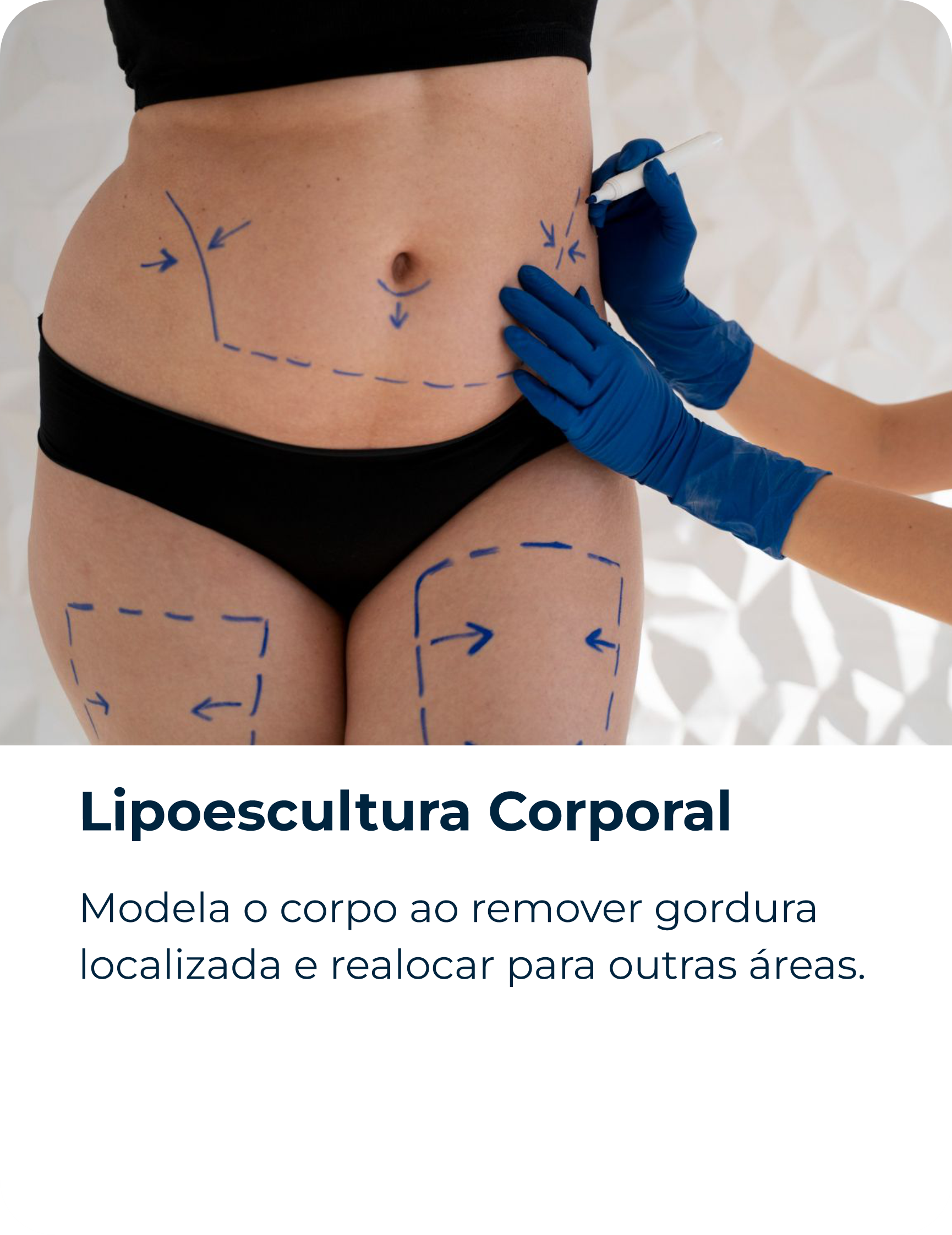 Lipoescultura Corporal