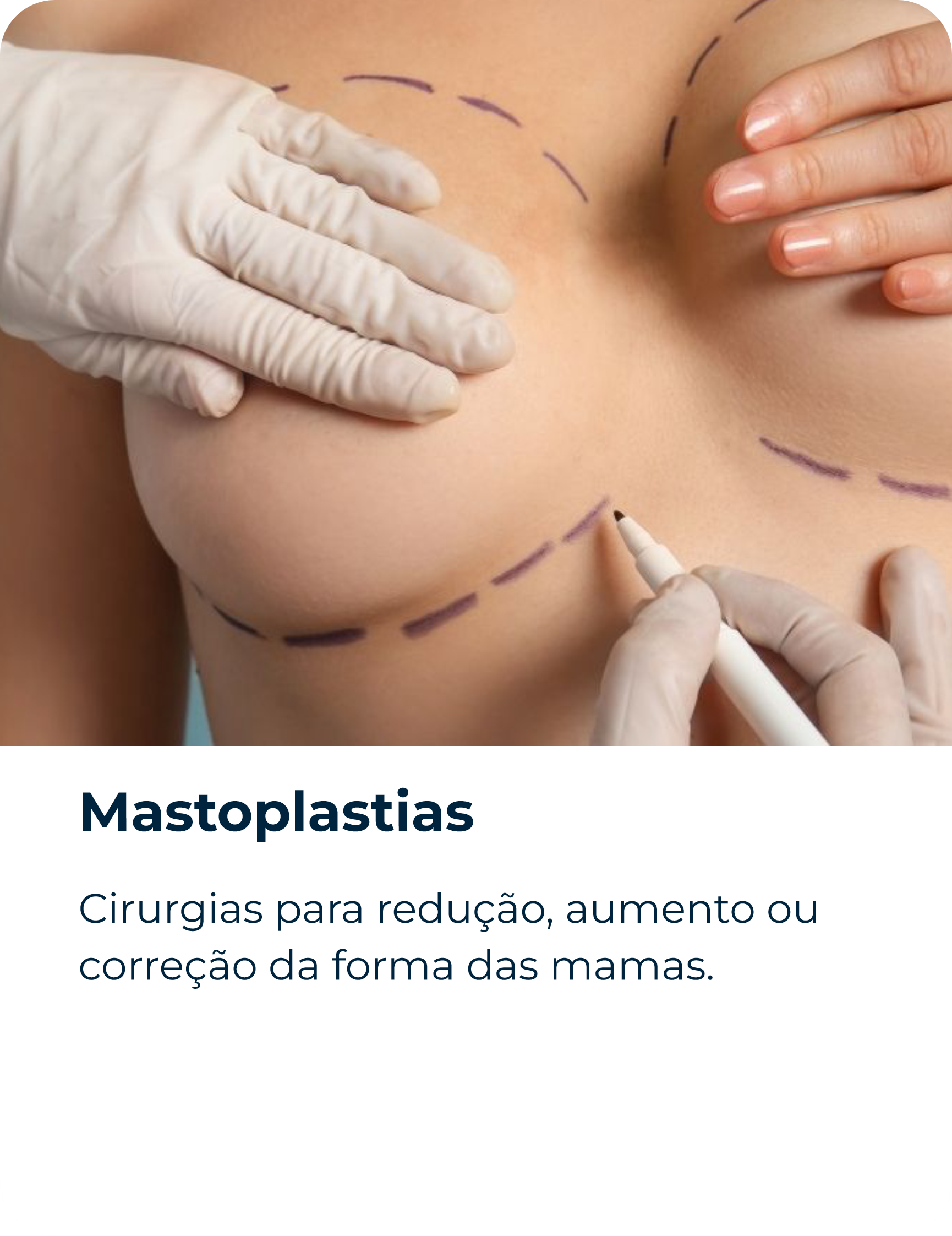 Mastoplastias
