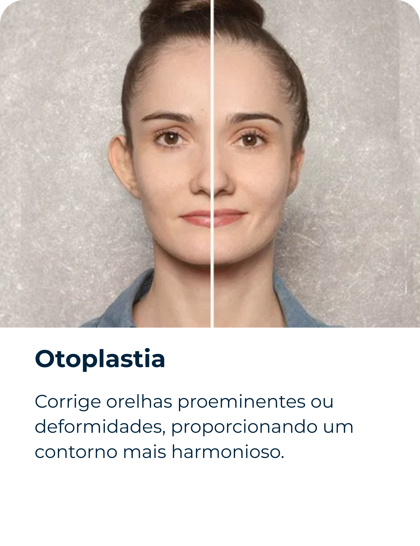 Otoplastia