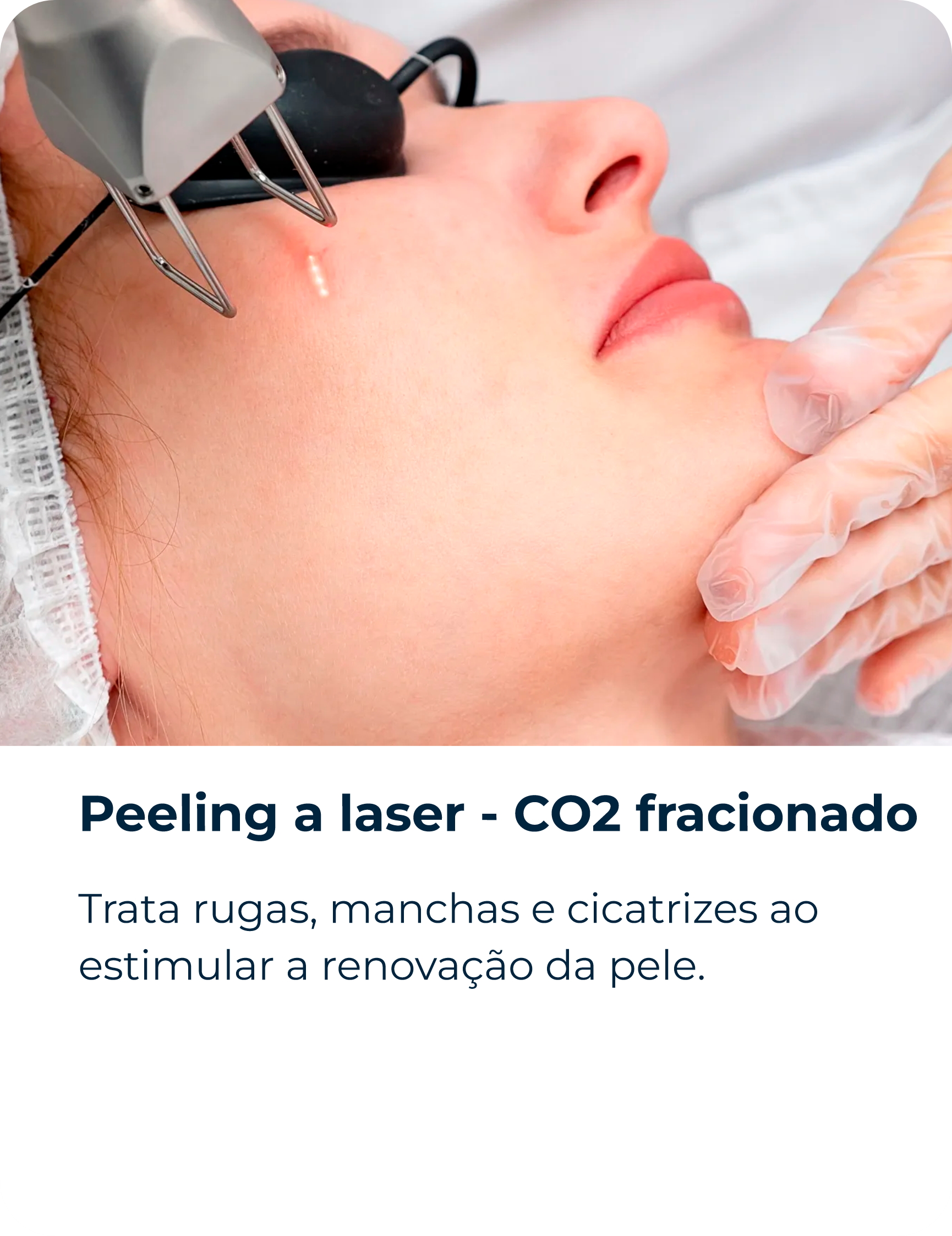 Peeling a laser - CO2 fracionado