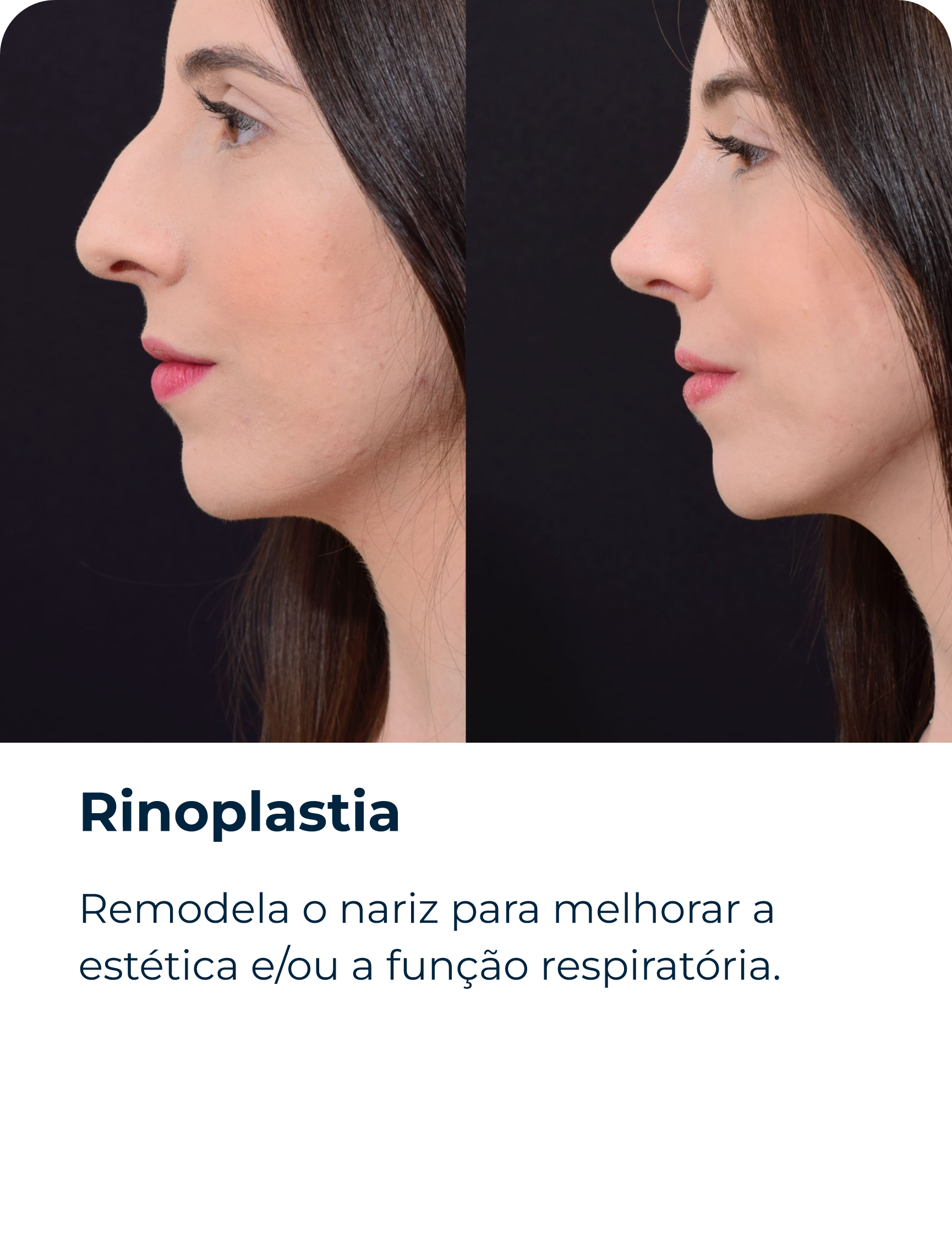 Rinoplastia